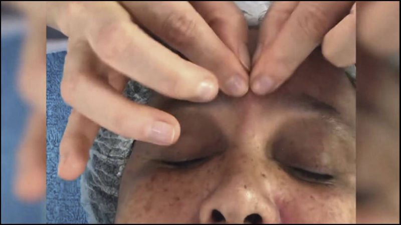 Harmonização Facial Isabel Piatti